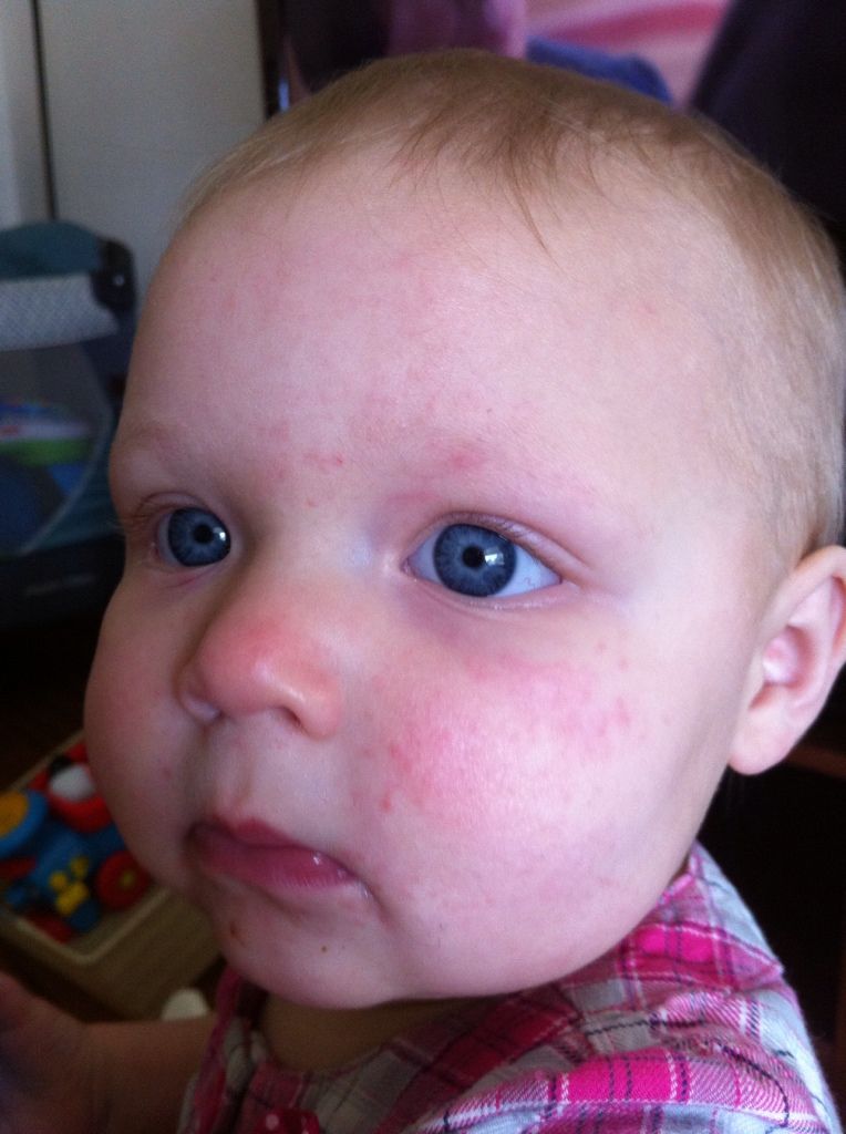 Rash Milk Allergy? Food Allergy? BabyCenter