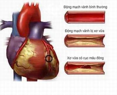 Điều trị bệnh tim mạch và cao mỡ máu bằng Lecithin