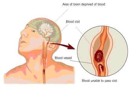 Nhồi máu não - Tai biến mạch máu não (Cerebral infarction)
